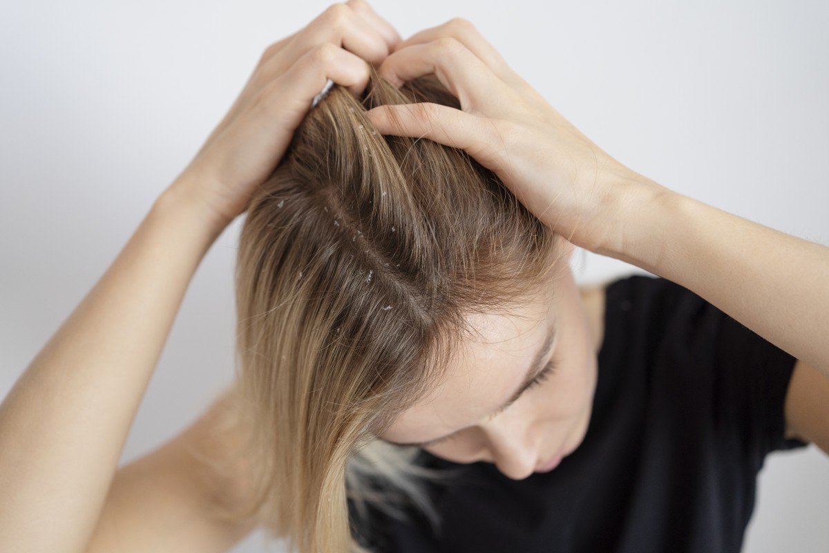 ¿Por qué tengo caspa si me lavo bien el cabello?